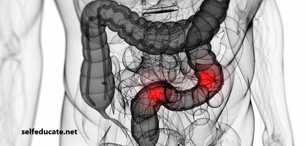 Irritable bowel syndrome treatment