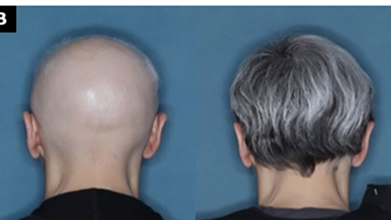 F.D.A. Approves Alopecia Drug That Restores Hair Growth in Many Patients
