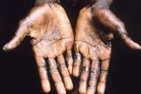Monkeypox: How it spreads, who’s at risk – here’s what you need to know |