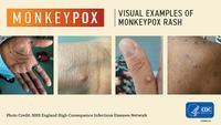 Emergency Committee meets again as Monkeypox cases pass 14,000: WHO |